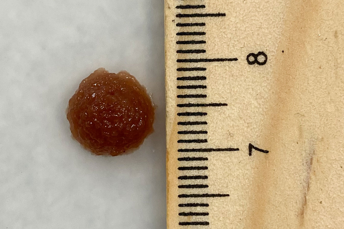 Tumor measured against ruler