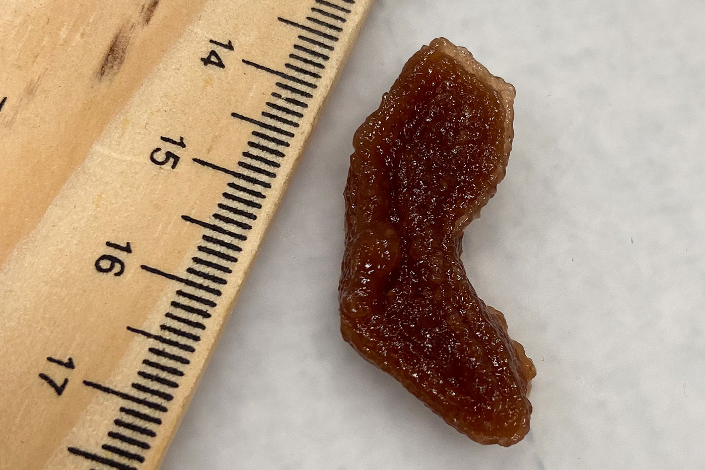 Tumor measured against ruler