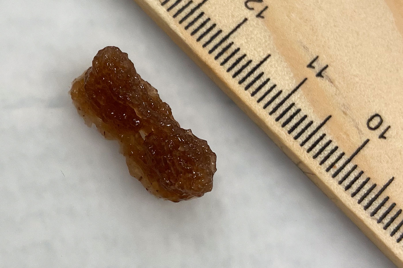 Tumor measured against ruler